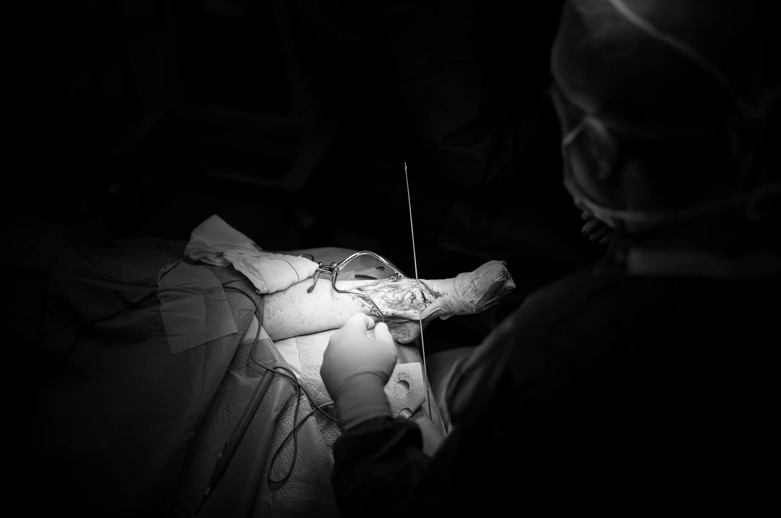 Cirugía de Reemplazo de Tobillo: La Revolución de los Implantes Personalizados en 3D